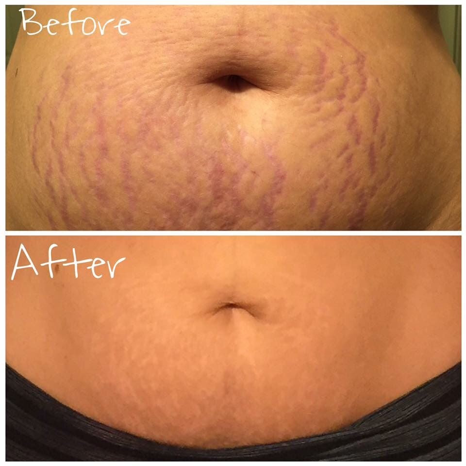 Stretch Mark Remover Cream