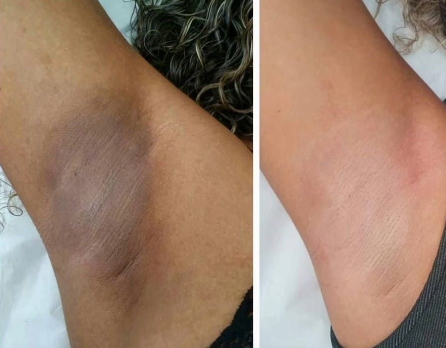 Underarm Lightening Cream