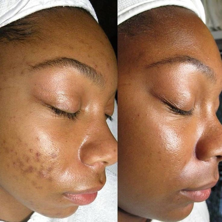 Dark spot remover oil